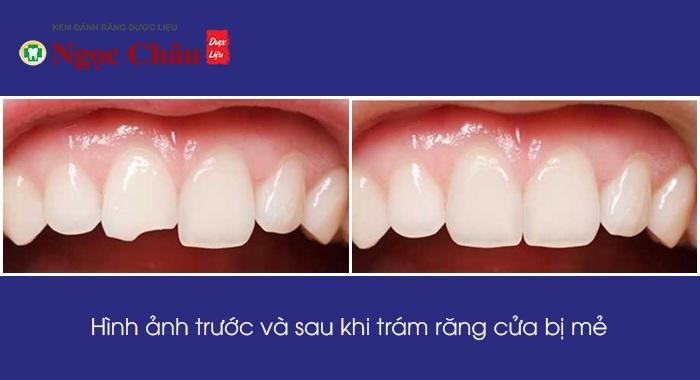 Hàn trám răng là bước đơn giản nhất để phục hình răng bị sứt mẻ