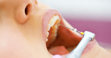 Đau nhức răng cửa hàm trên hàm dưới – Nguyên nhân và cách điều trị