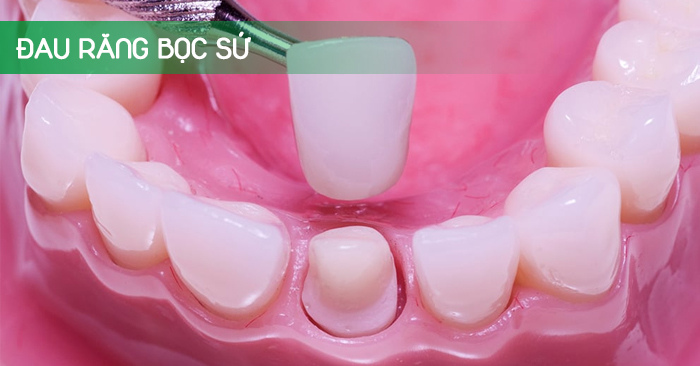 Nếu răng bọc sứ lâu năm bị đau nhức, có cần đến nha khoa để kiểm tra và điều trị?
