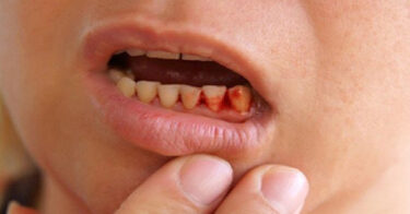 Trẻ em bị chảy máu chân răng – Nguyên nhân và cách điều trị