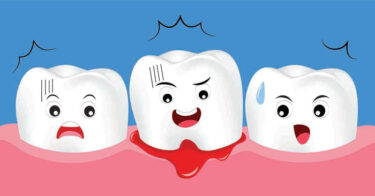 Ê buốt răng kèm chảy máu chân răng có nguy hiểm không?