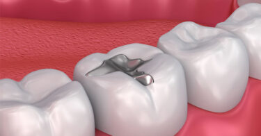 Ê răng sau khi trám – Nguyên nhân và cách chữa trị