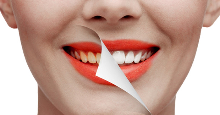 Sử dụng miếng dán trắng răng đang được nhiều người áp dụng