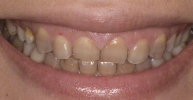 Nguyên nhân, cách điều trị khi răng bị nhiễm Tetra