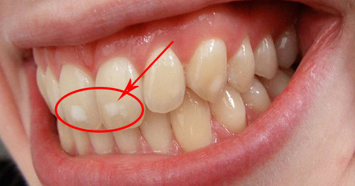 Răng bị nhiễm Fluor – Nguyên nhân, cách điều trị
