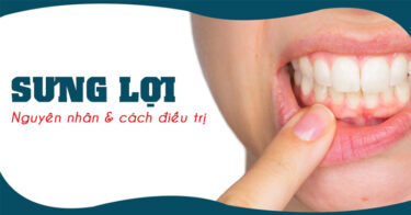 Sưng lợi (sưng nướu răng) – Nguyên nhân và cách điều trị