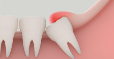 Viêm lợi trùm răng khôn – Nguyên nhân và cách điều trị